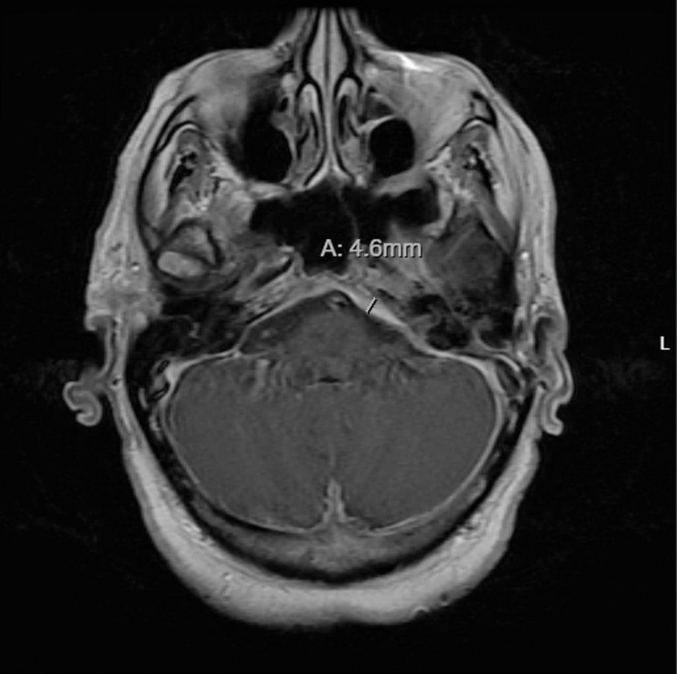 Cureus | IgG4-Related Disease Presenting as Hypertrophic Pachymeningitis