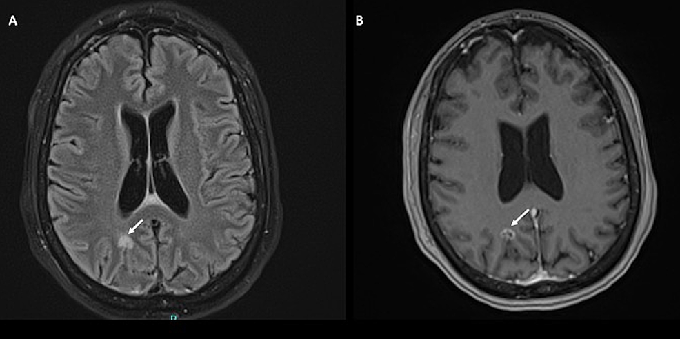 MRI-of-the-brain-with-and-without-contrast.