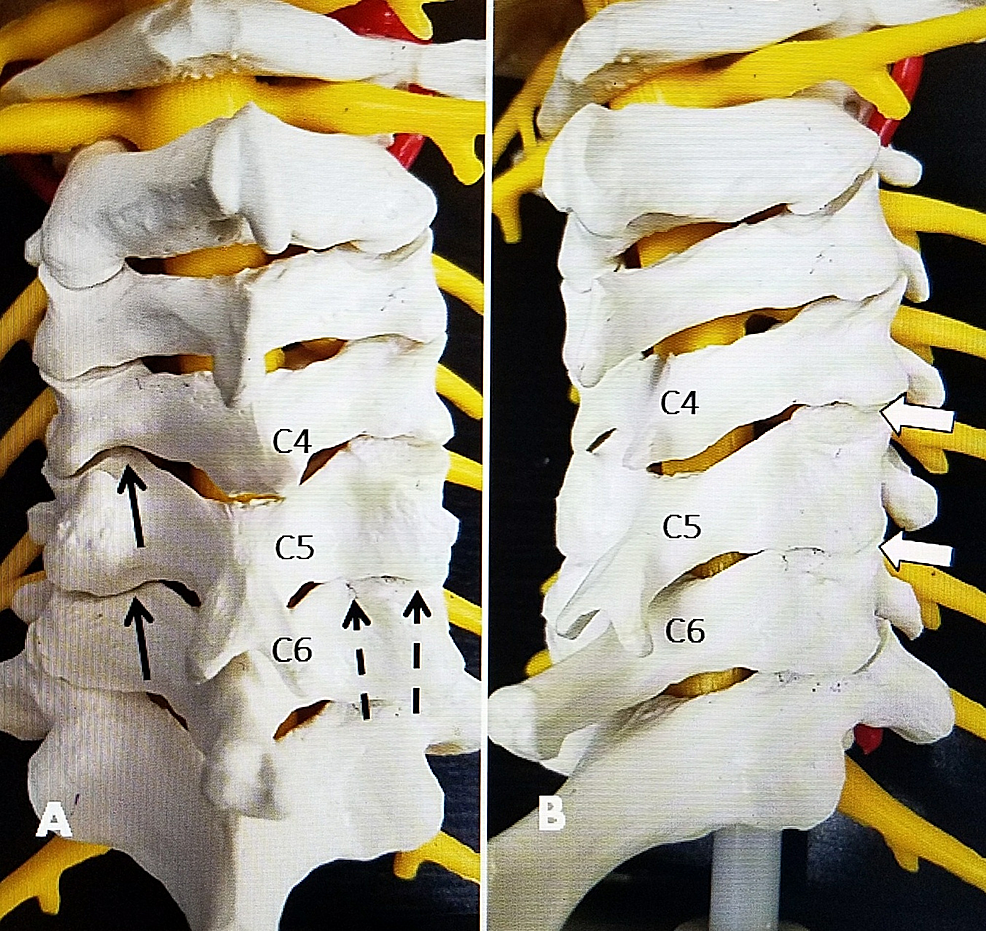 cureus-direct-posterior-bipolar-cervical-facet-radiofrequency