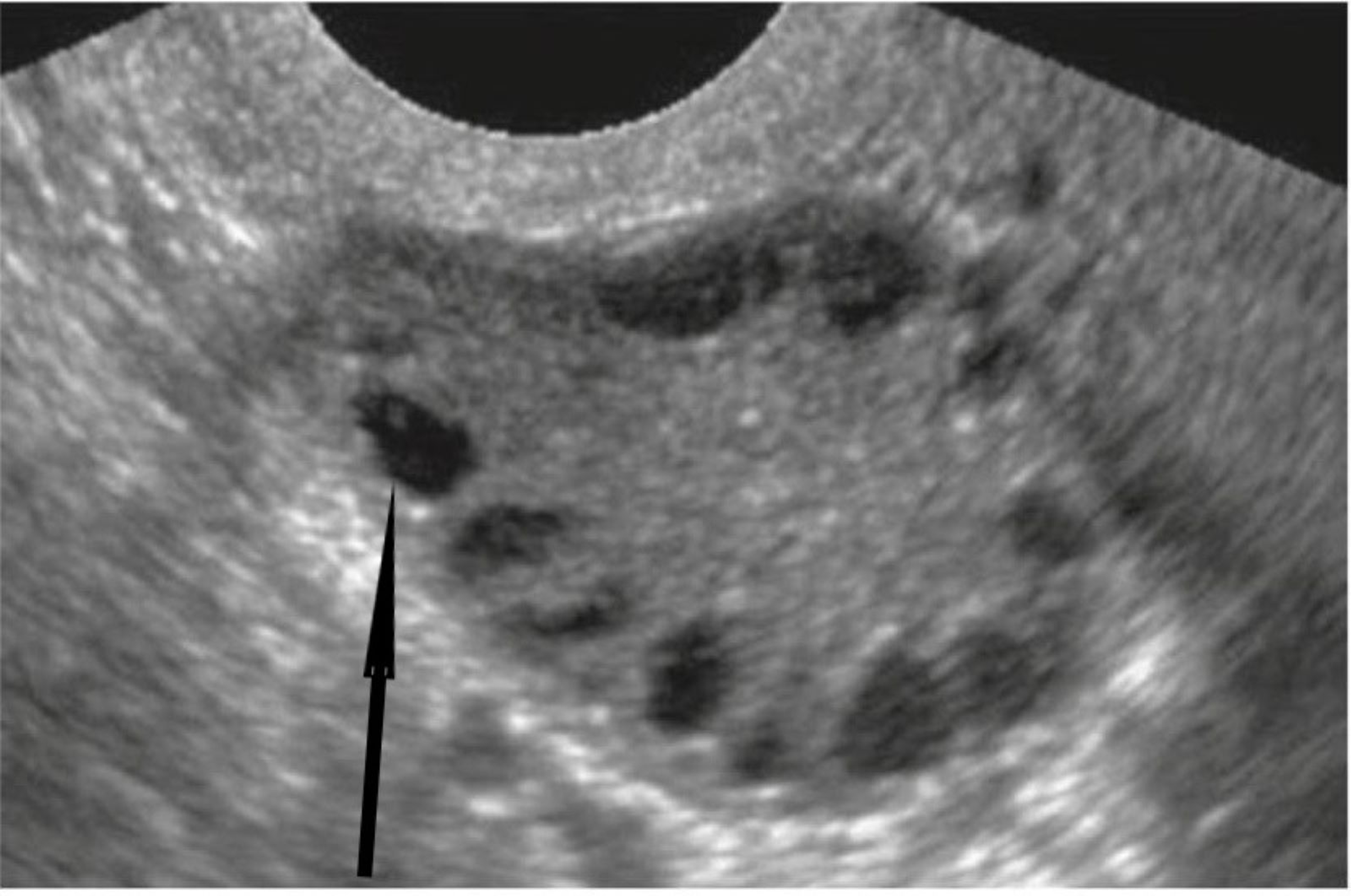 normal vs polycystic ovaries ultrasound