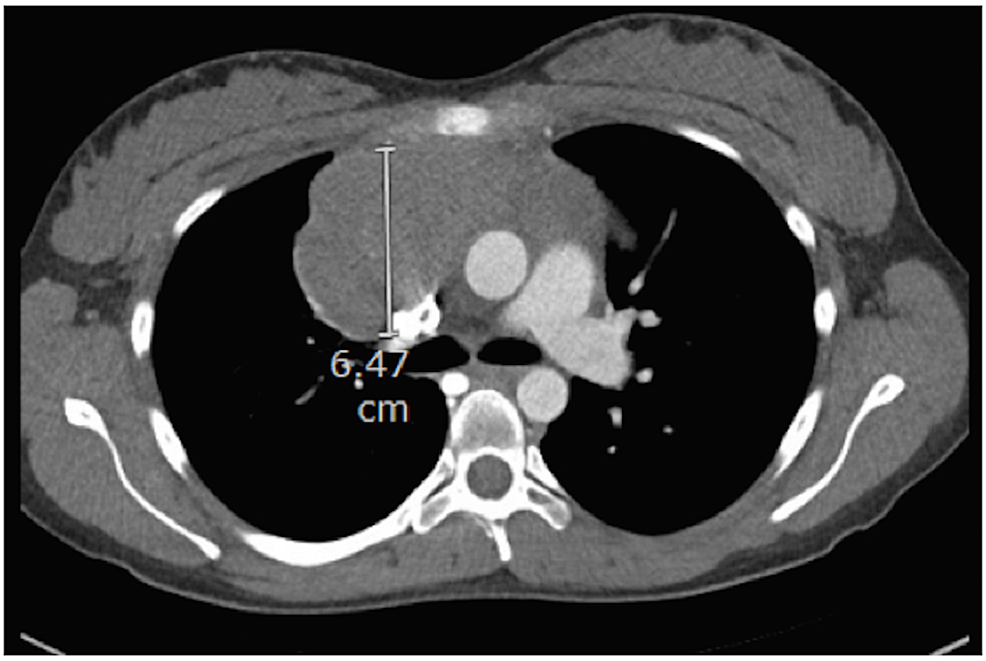 cureus-management-of-primary-mediastinal-b-cell-lymphoma-in-pregnancy