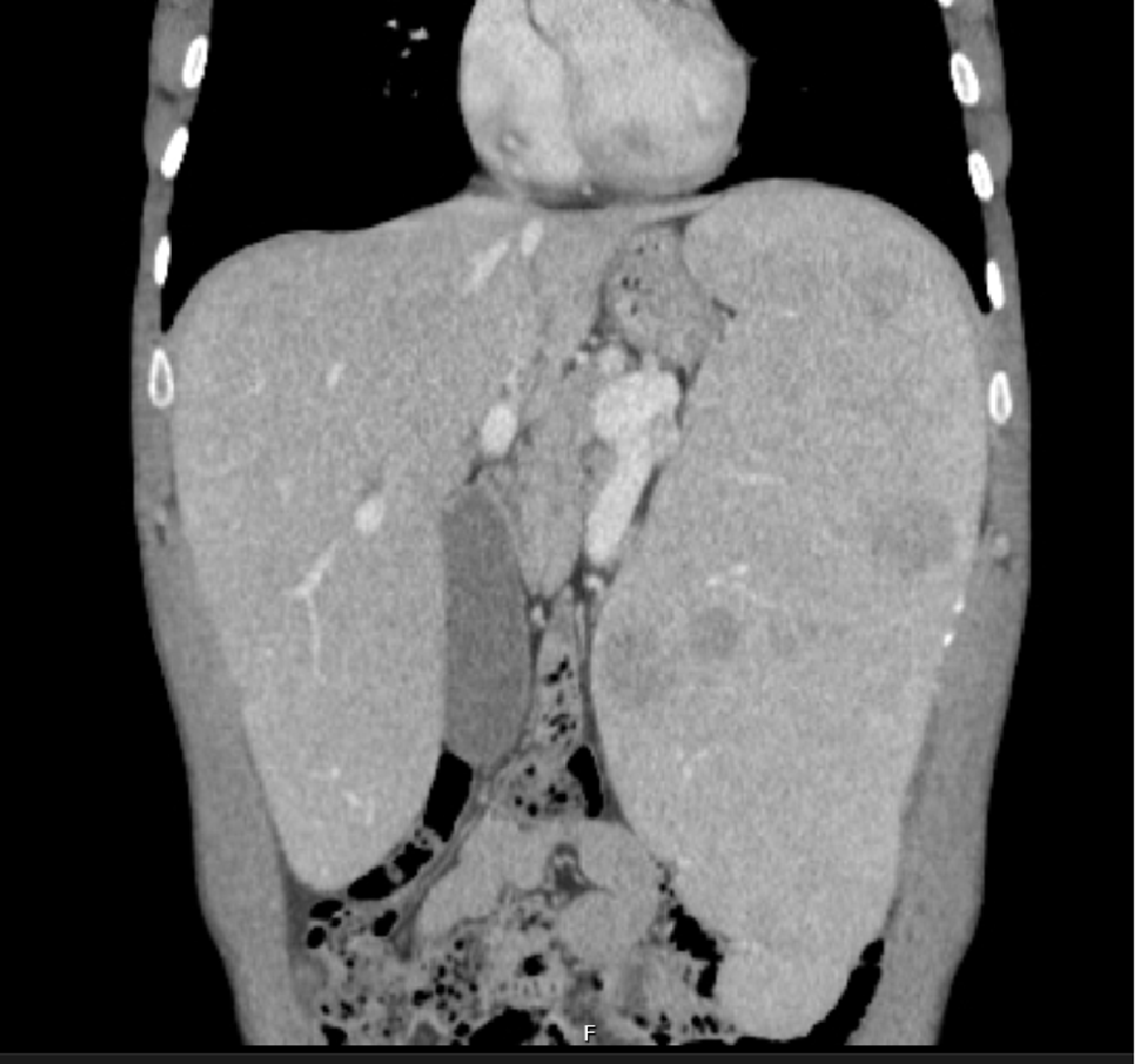 Cureus NiemannPick Type B A Rare Cause of Interstitial Lung Disease