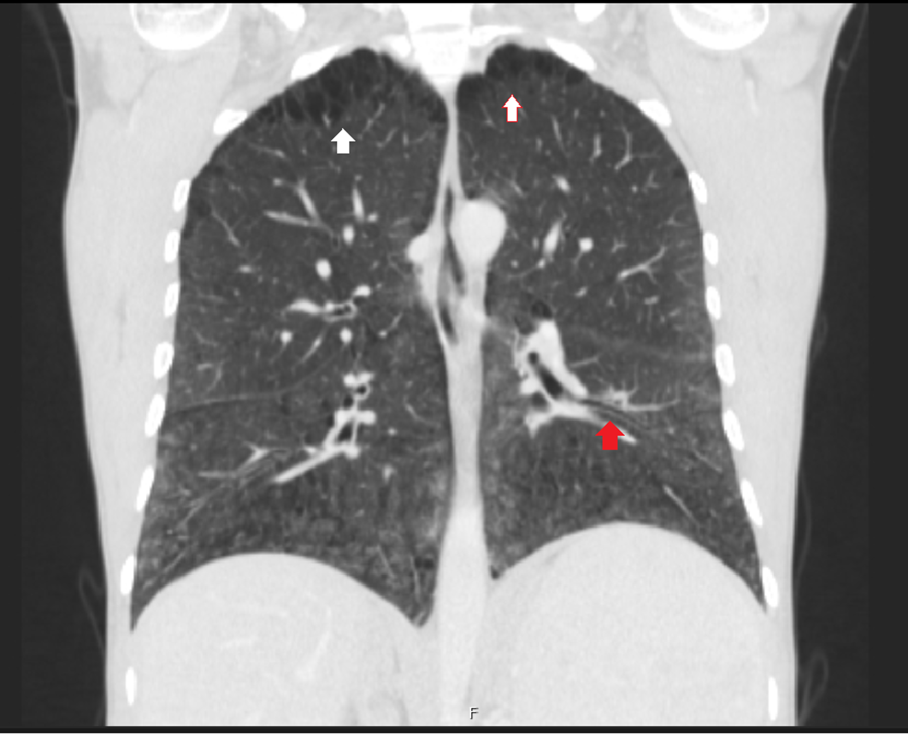 Cureus NiemannPick Type B A Rare Cause of Interstitial Lung Disease