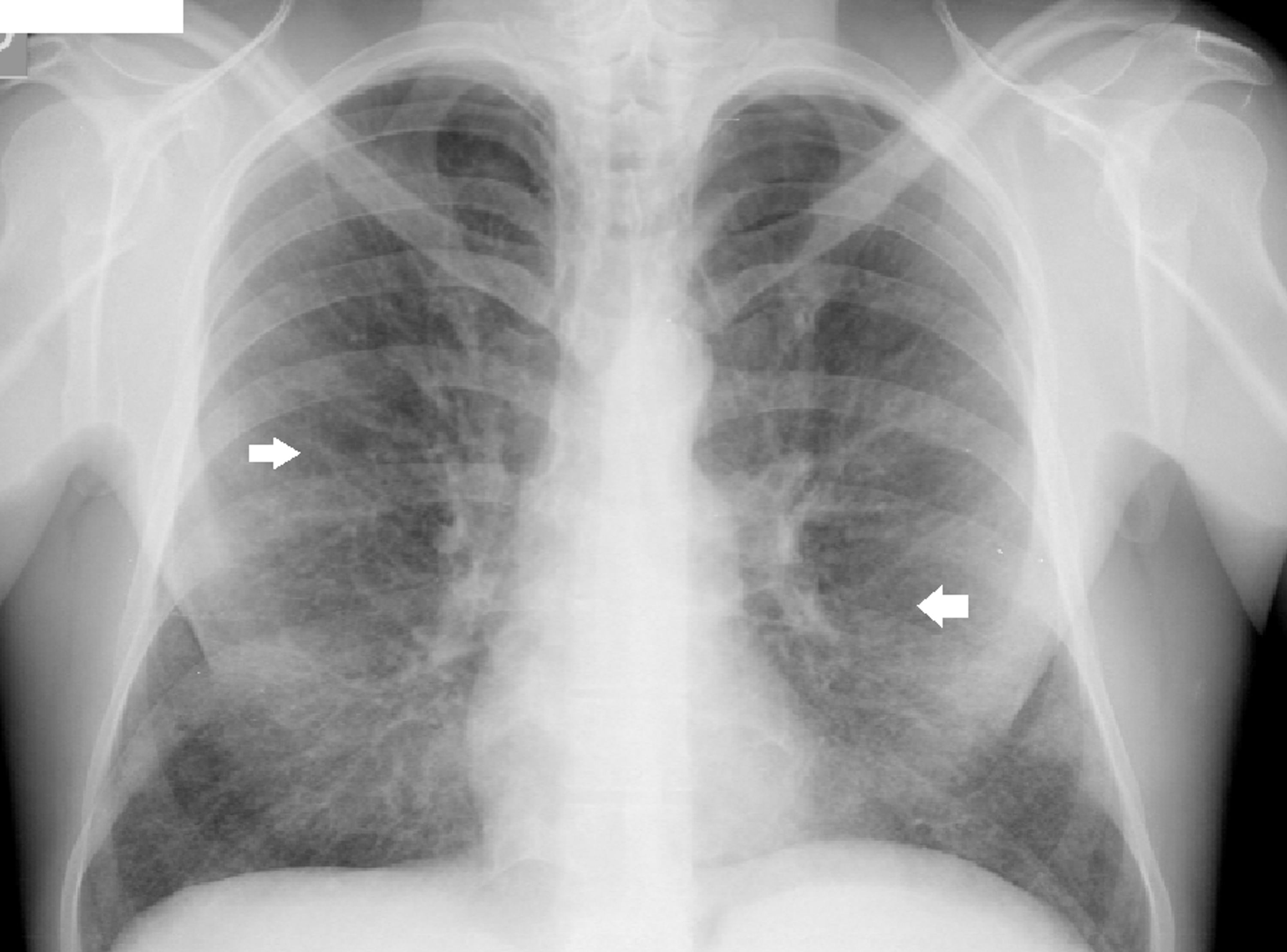 Cureus | Niemann-Pick Type B: A Rare Cause of Interstitial Lung Disease