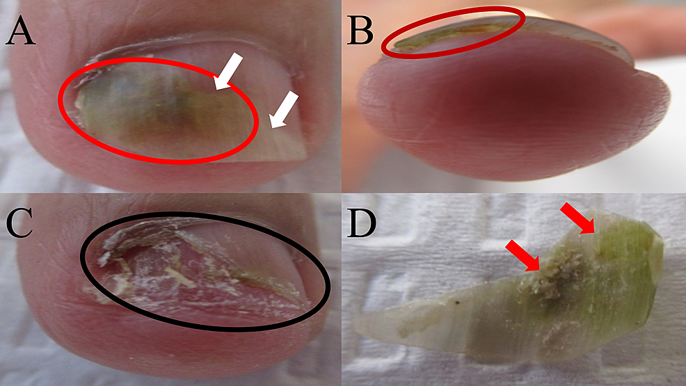 Fungal-viridionychia-secondary-to-Candida-parapsilosis-presenting-as-green-nail-syndrome-of-the-left-fourth-fingernail.