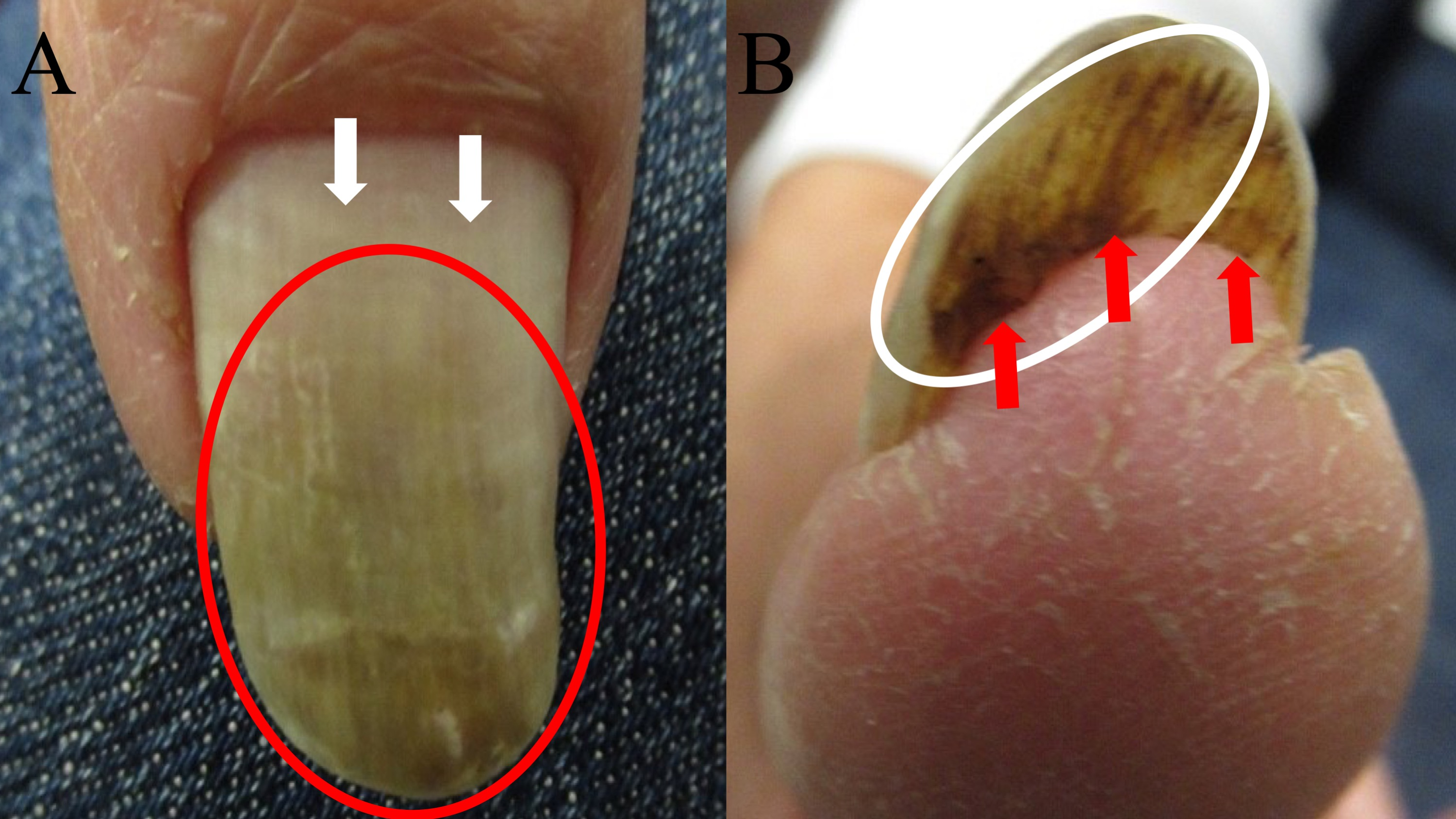 Cureus | Fungal Viridionychia: Onychomycosis-Induced Chloronychia Caused by  Candida parapsilosis-Associated Green Nail Discoloration | Article