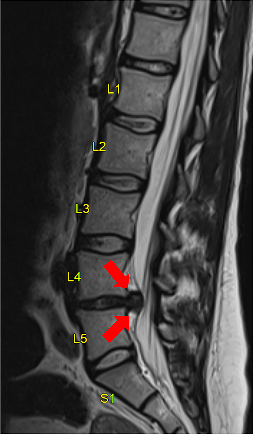 Sagittal-MRI-of-the-lumbar-spine.
