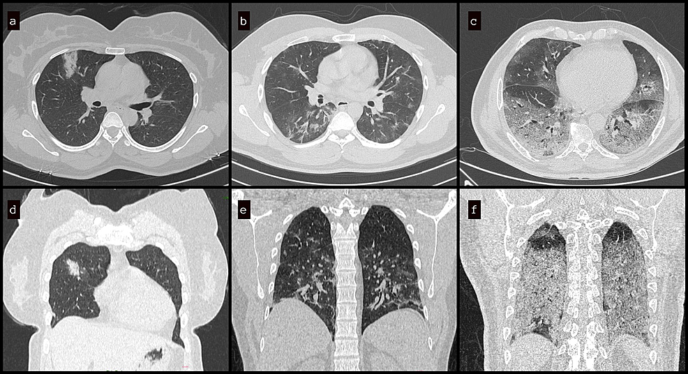 correlation-between-ct-severity-scoring-and-diabetes-mellitus-in