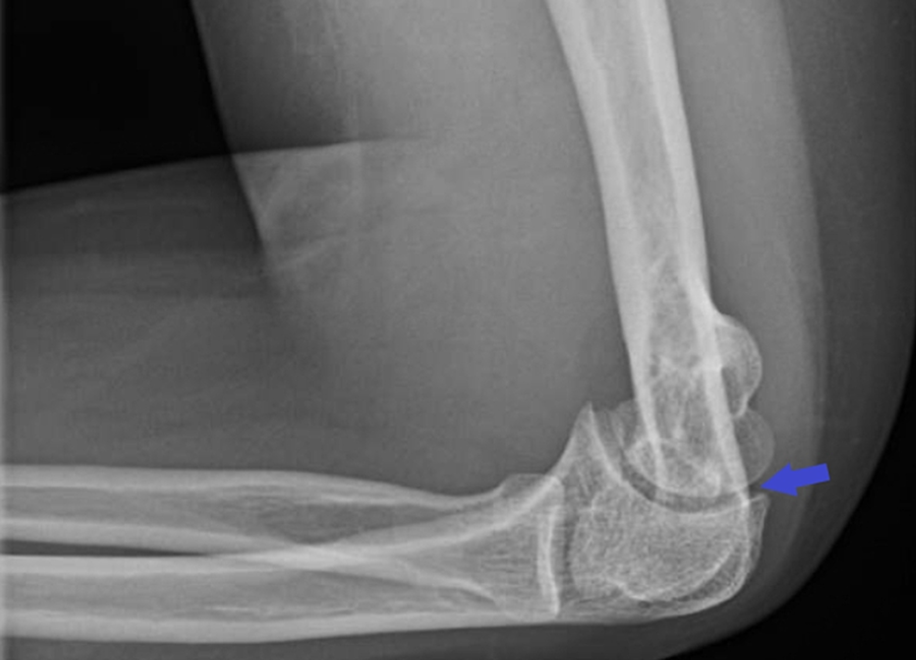 Cureus A Rare Case of Septic Arthritis, Osteomyelitis