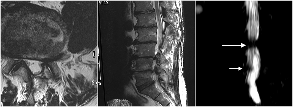 Lumbar Spinal Stenosis - Oxford Spine & Neuro