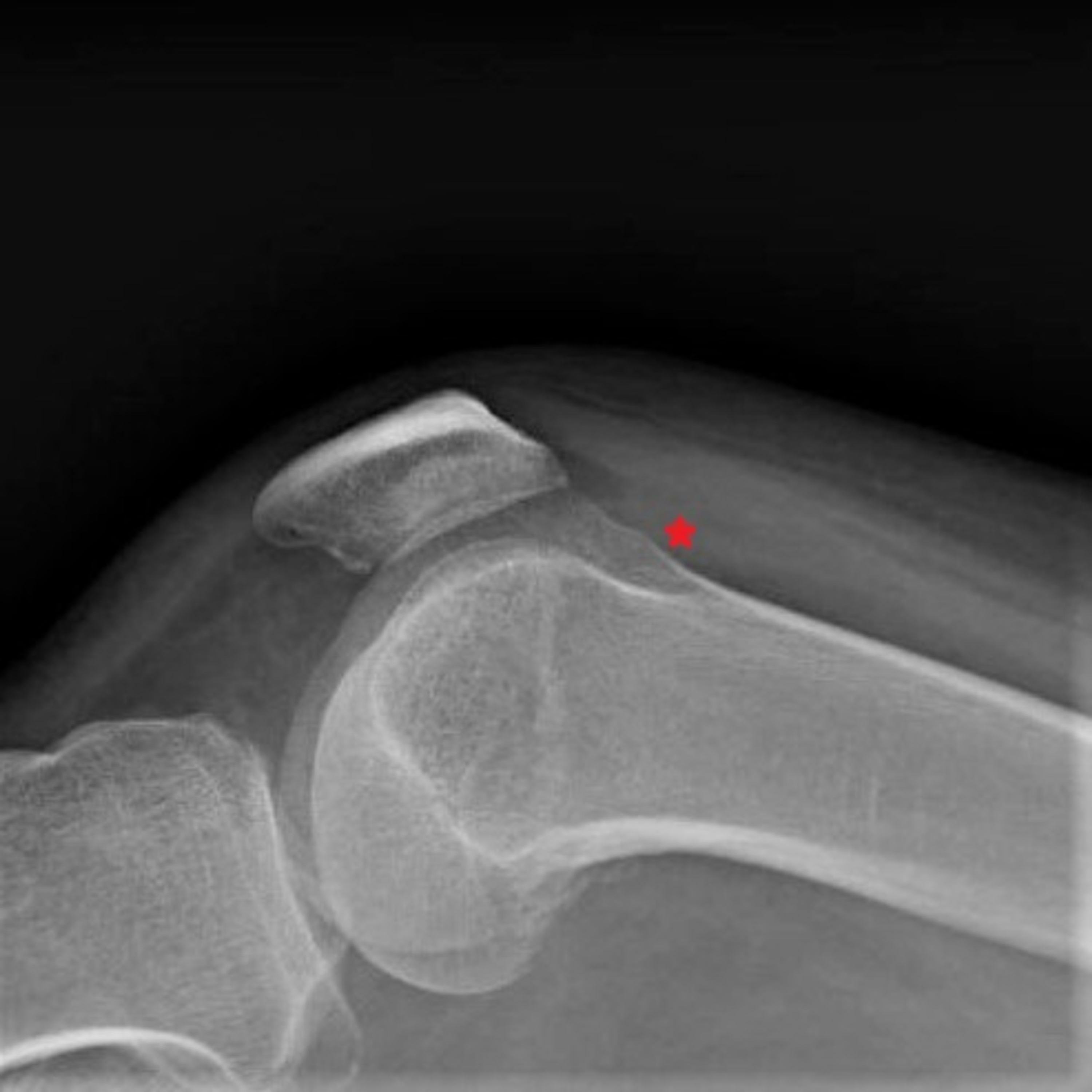 Cureus Salmonella Septic Arthritis and Bacteremia in a Patient With