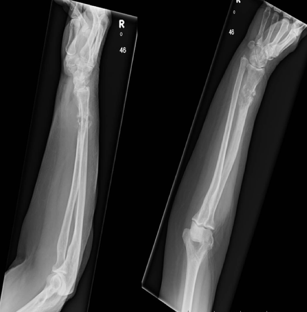 Cureus A Rare Presentation of a Solitary Melanoma Bone Metastasis