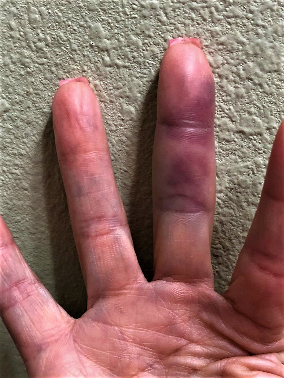 bruised middle finger