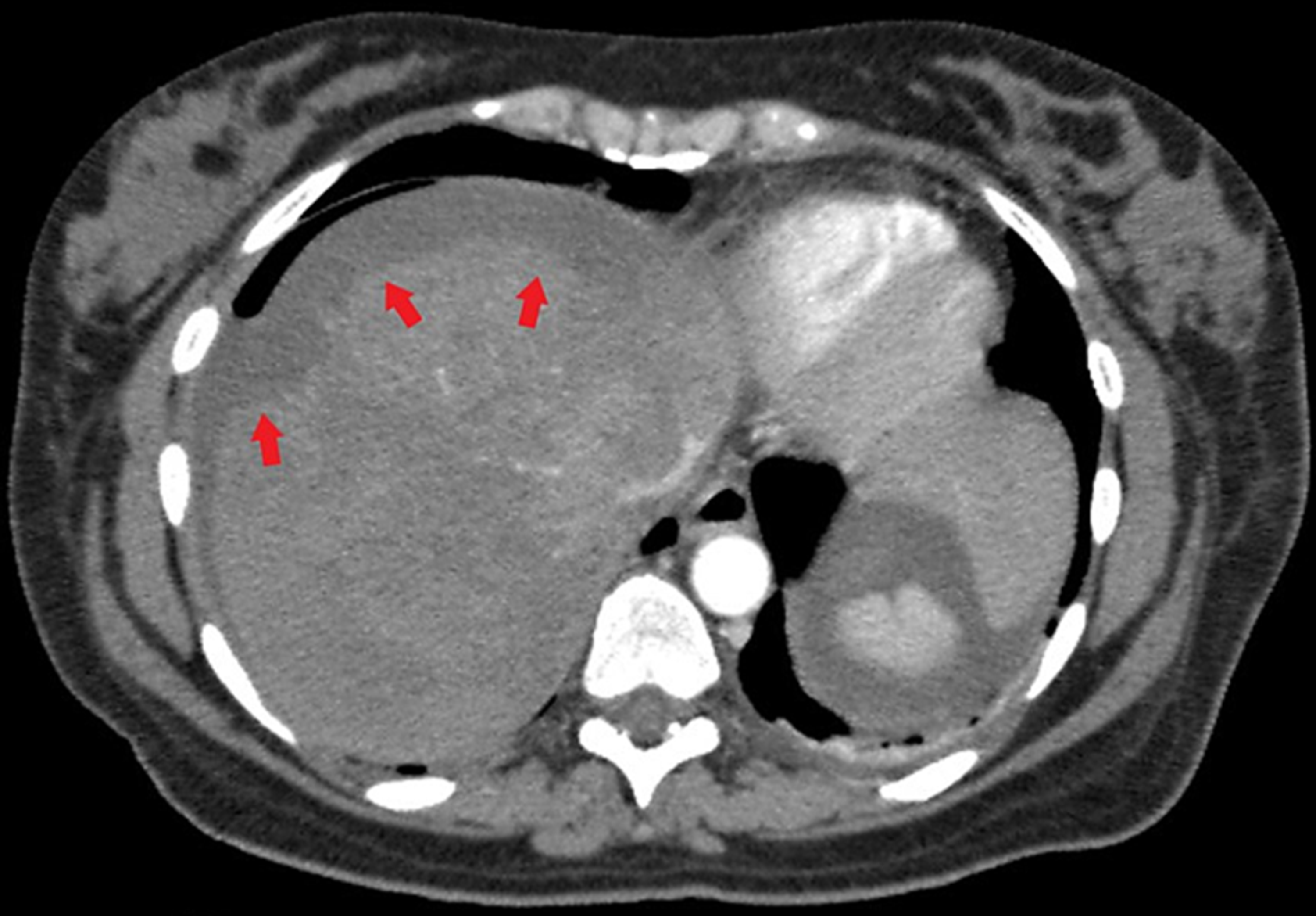 Cureus Subcapsular Liver Hematoma A Rare Complication of Hemolysis