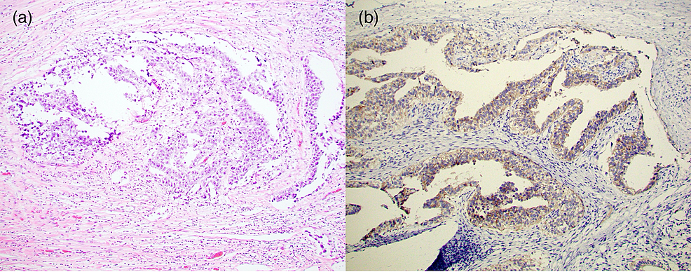 Cureus Synchronous Bilateral Primary Testicular Tumors With