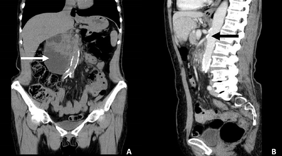 Cureus | Wilkie's Syndrome: An Unexpected Finding