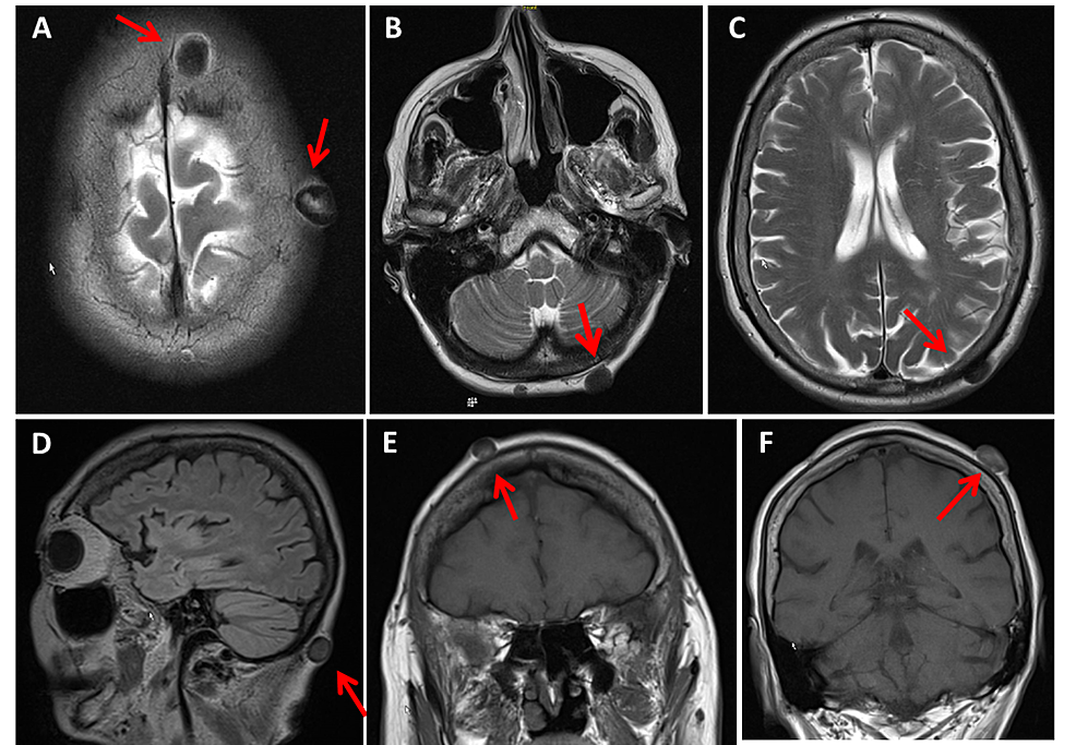 Cureus | Atheromatosis of the Scalp: A Novel Feature of Chronic ...