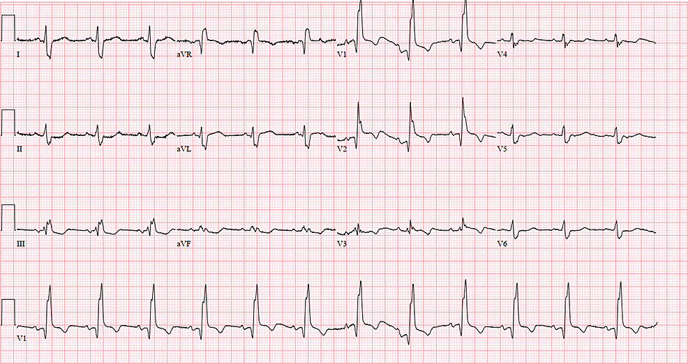 A Case of ST-Elevation Myocardial Infarction With Right Bundle Branch ...