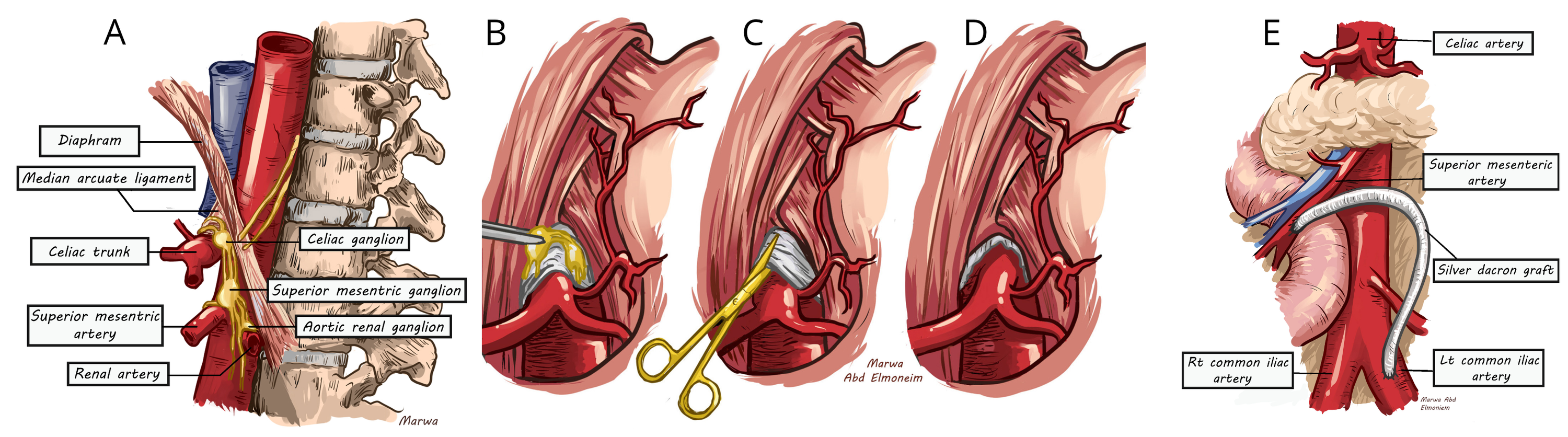 Cureus Two Decades Of Experience With Chronic Mesenteric Ischaemia And Median Arcuate Ligament Syndrome In A Tertiary Referral Centre A Parallel Longitudinal Comparative Study Cureus Two Decades Of Experience With Chronic Mesenteric Ischaemia And Median Arcuate Ligament Syndrome In A Tertiary Referral Centre A Parallel Longitudinal Comparative Study