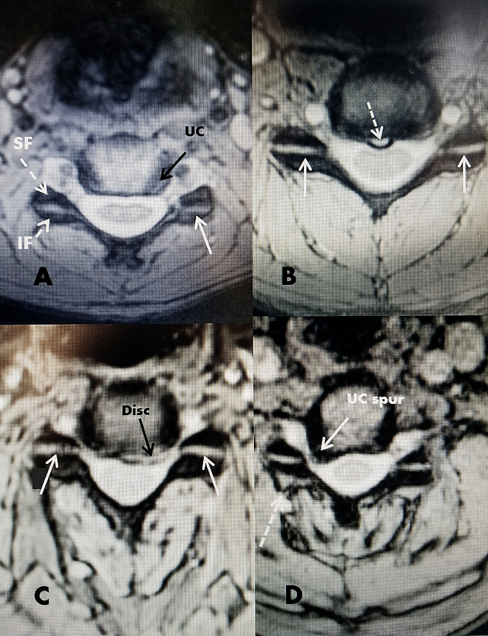 Cureus Direct Posterior Bipolar Cervical Facet Radiofrequency