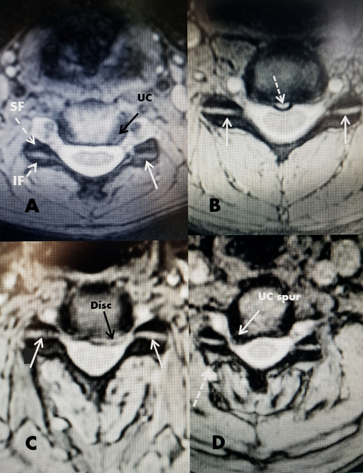 Cureus Direct Posterior Bipolar Cervical Facet Radiofrequency