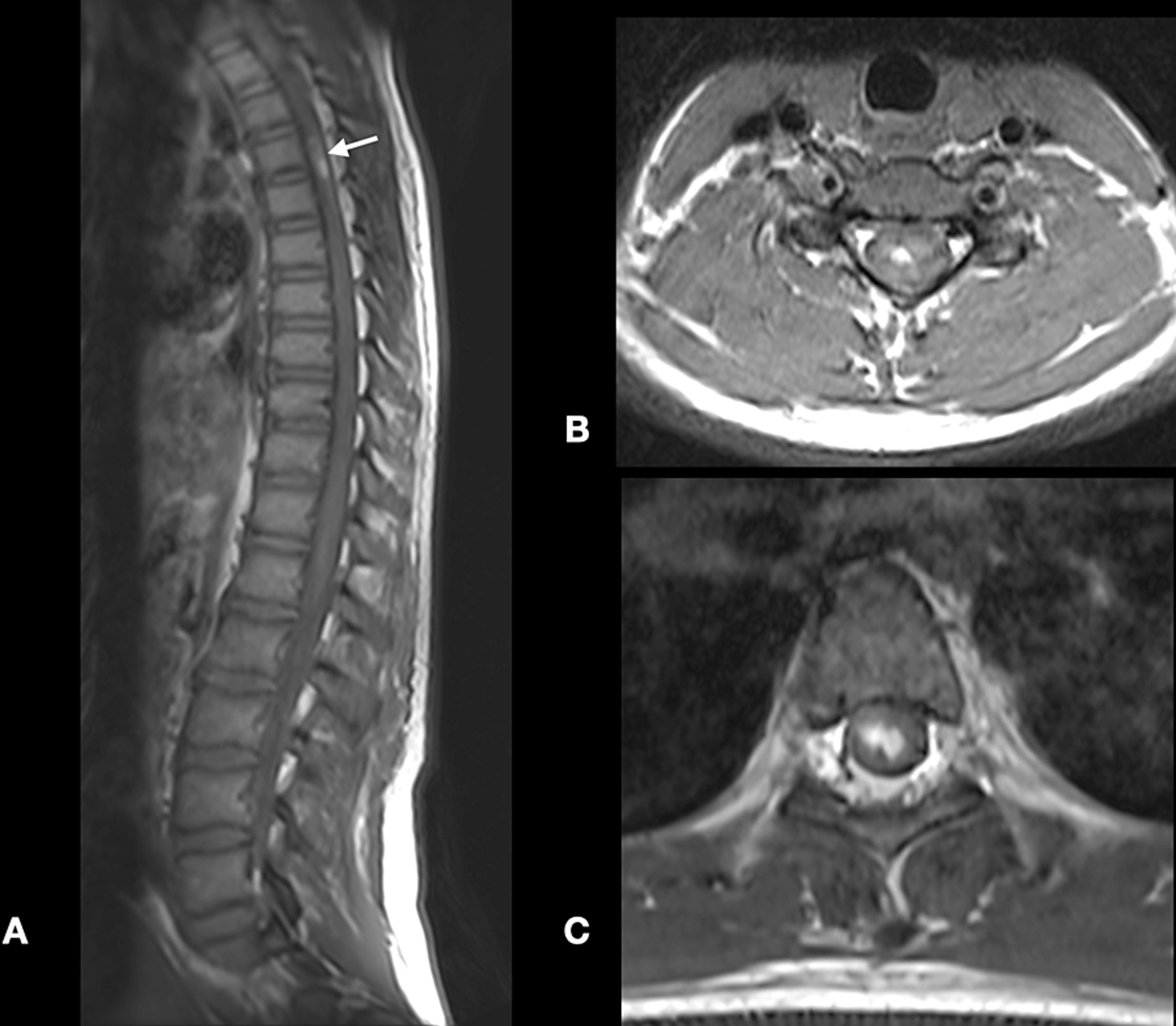 Cureus | Acute Hemorrhagic Myelitis In An Adolescent With COVID-19: A ...