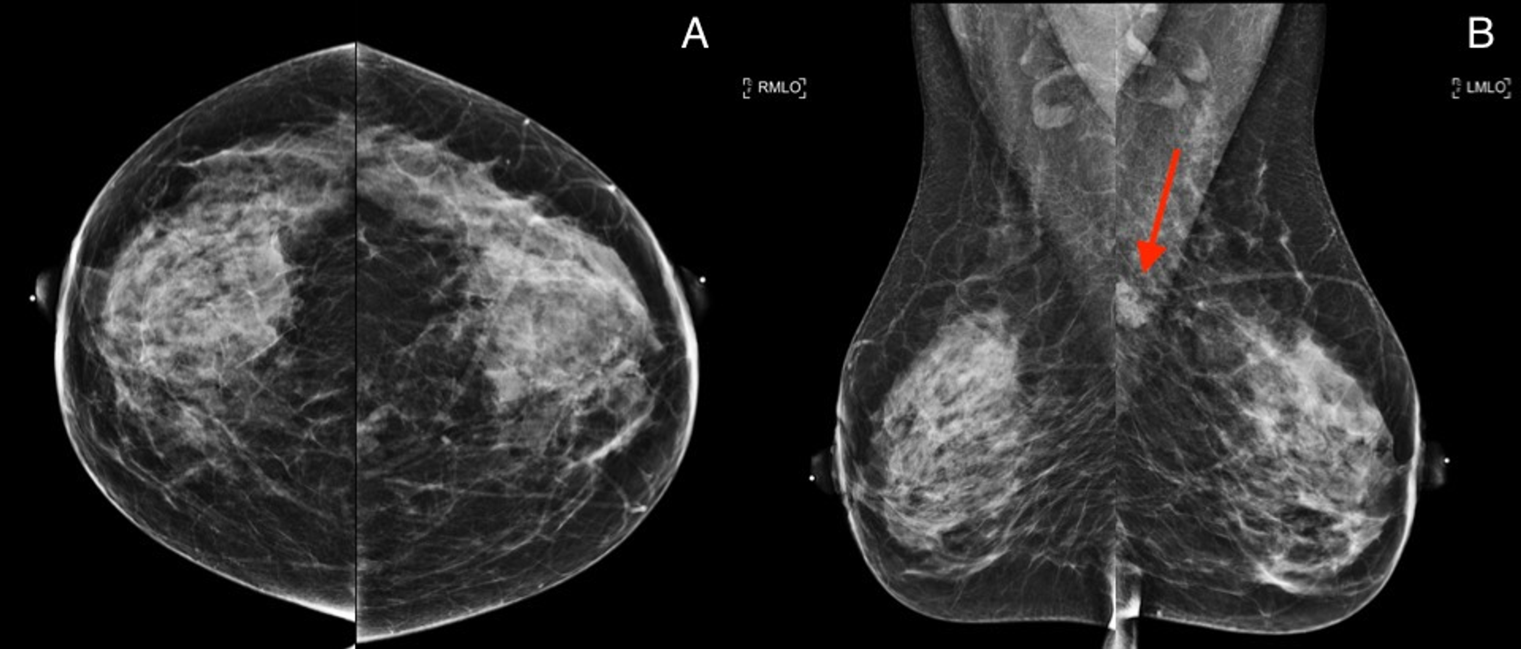 Cureus | Challenging Biopsy of a Benign Breast Lesion With Malignancy ...