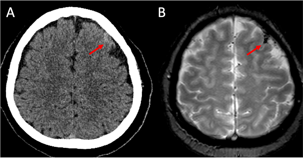 健康・医学 Occlusion Angiography in left anterior oblique(LAO) 45° and cranial 25