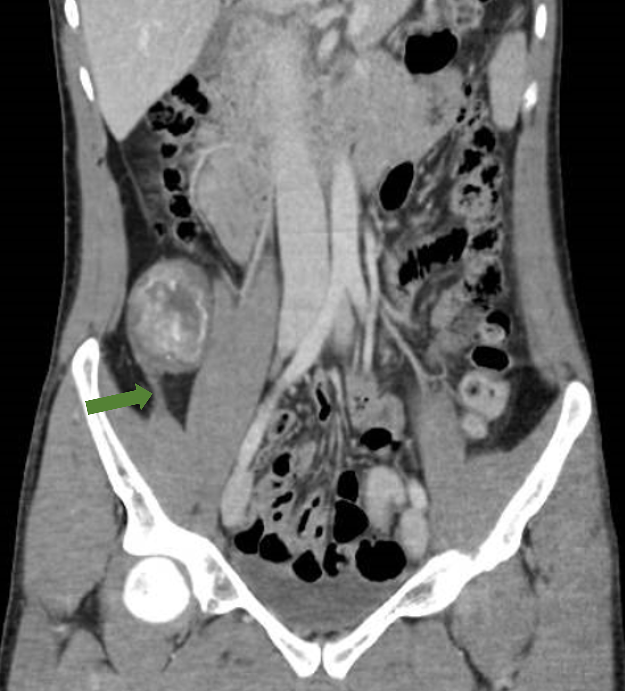 Cureus Retroperitoneal Knee Pain An Unusual Case Report And Review