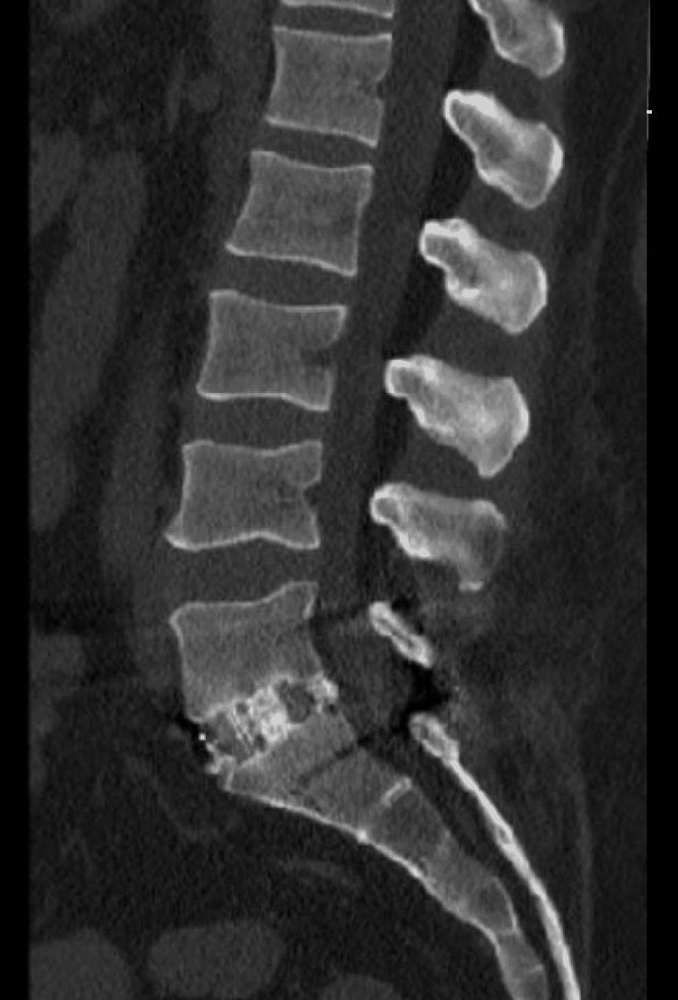 Sagittal-CT-lumbar-spine.