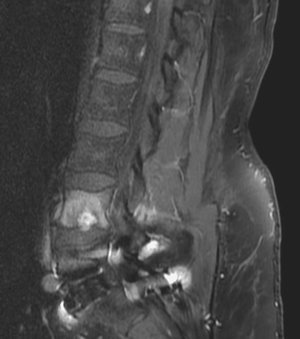 Sagittal-MRI-short-tau-inversion-recovery-sequence-with-lombar-4-Schmorl's-node.