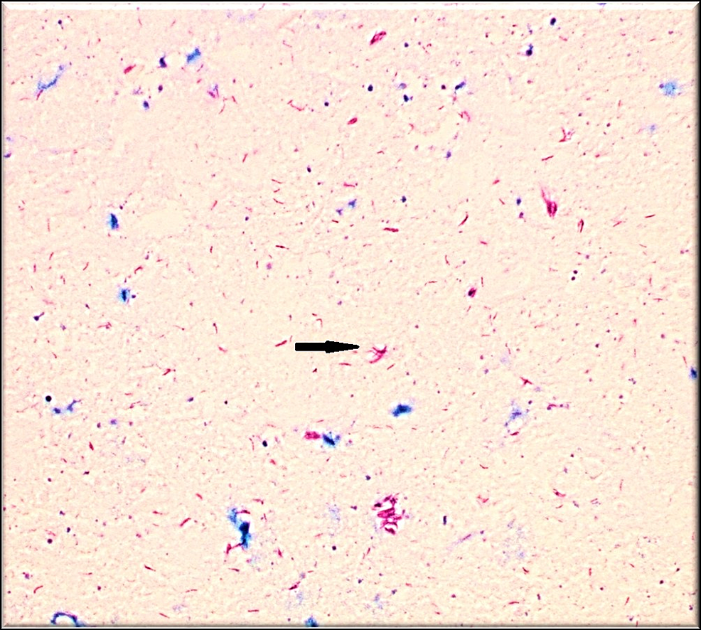 Cureus | Nontuberculous Mycobacterial Infection Mimicking Inflammatory ...