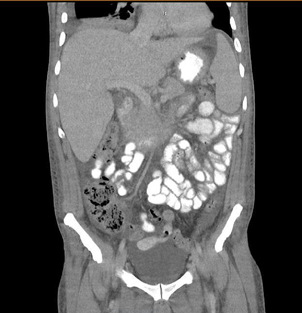 CT-scan-of-abdomen-and-pelvis-showing-pleural-effusion-and-hepatosplenomegaly