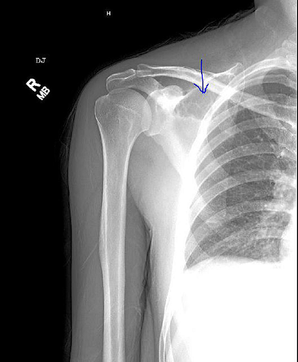 X-ray-of-the-right-shoulder