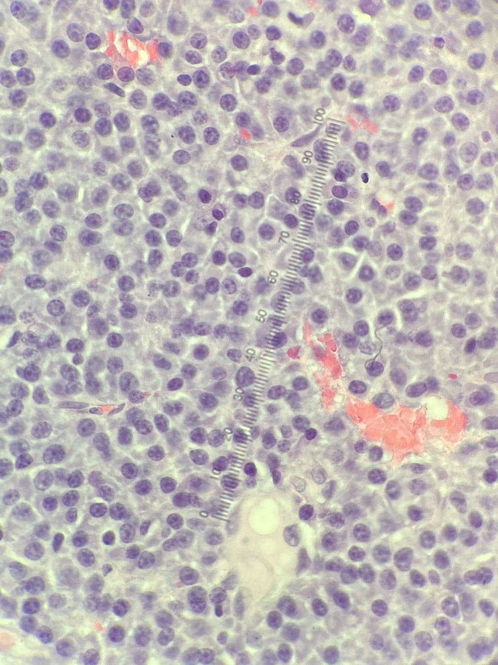 Pathological-smear-showing-diffuse-sheets-of-CD138-positive-plasma-cells