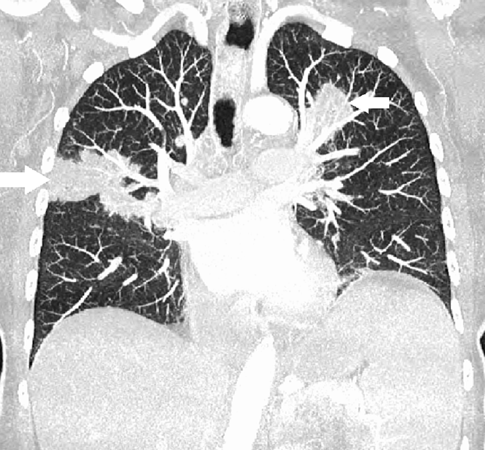 Elderly Onset Sarcoidosis: A Case Report | Cureus