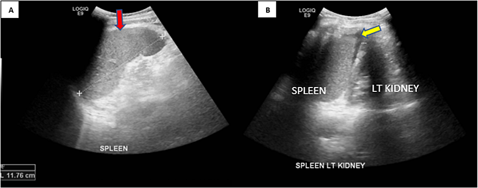 Ultrasound-abdomen-showing-A)-mildly-enlarged-spleen-measuring-11.76-cm-(red-arrow)-and-B)-trace-of-fluid-in-the-splenorenal-space-(yellow-arrow)