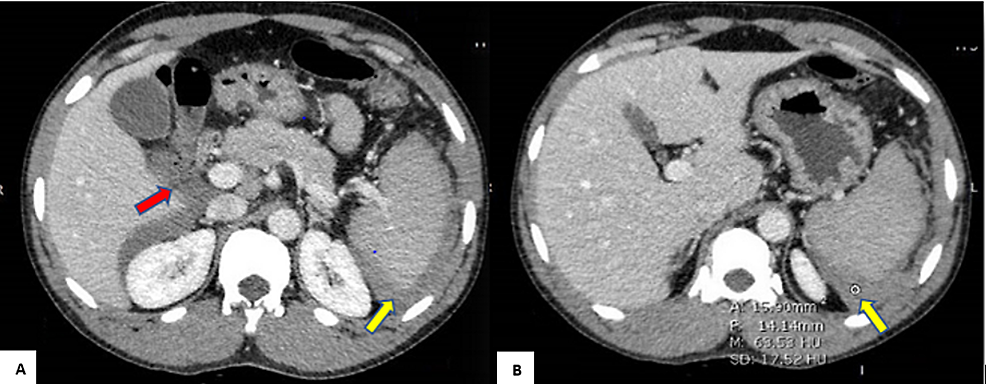 A)-&-B)-computed-tomography-with-intravenous-contrast,-axial-cuts-showing-right-upper-abdomen-hemoperitoneum-(red-arrow),-and-perisplenic-hematoma-(yellow-arrows)