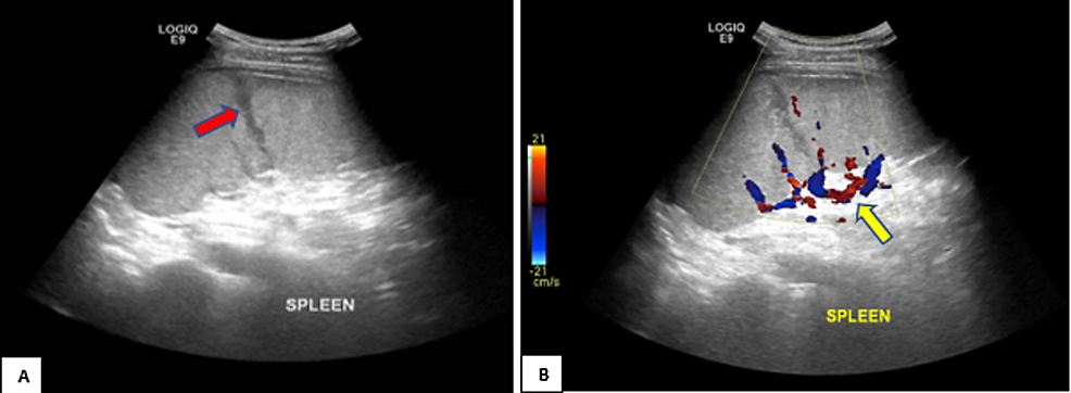 Ultrasound-abdomen-showing-A)-focal-hypoechoic-linear-area-in-the-spleen-extending-from-the-cortex-(red-arrow)-and-B)-no-vascularity-on-Doppler-imaging-(yellow-arrow)