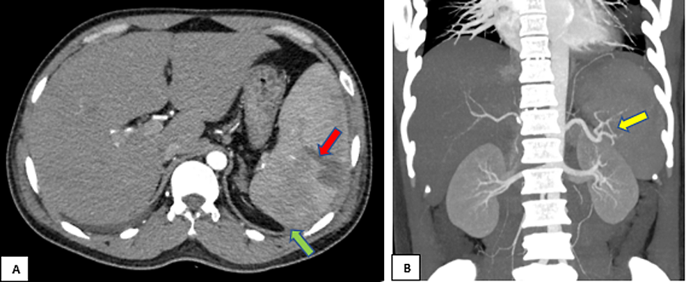 Computed-tomography-with-intravenous-contrast-A)-axial-and-B)-coronal-cuts-showing-a-hypodense-parenchymal-laceration-at-the-posterior-aspect-of-the-spleen-(red-arrow)-with-mild-perisplenic-hematoma-(green-arrow)-and-intact-splenic-artery-(yellow-arrow)