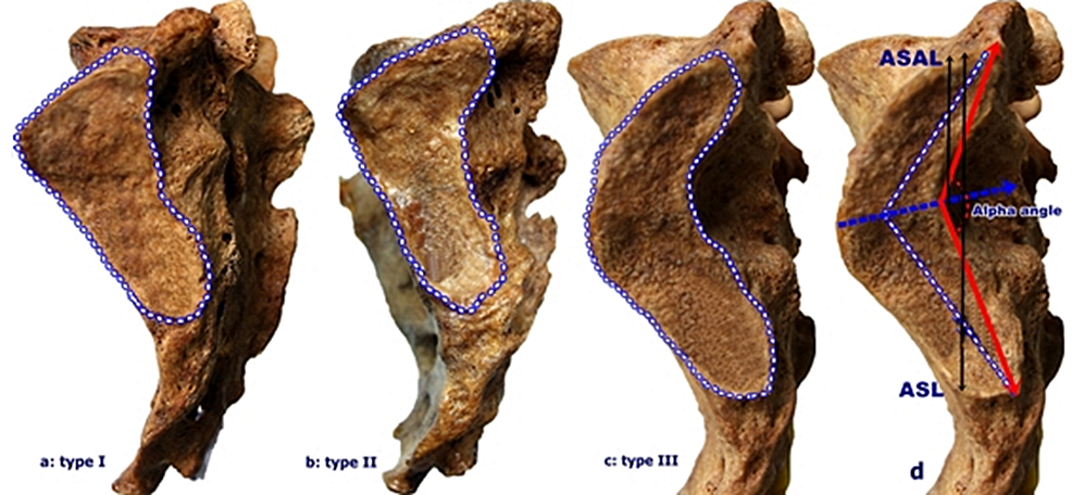 Cureus | Morphometric Examination Of The Sacroiliac Region And Variable ...