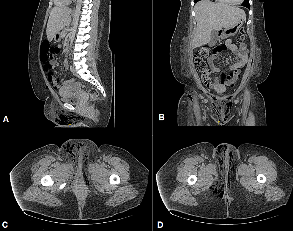 fournier-s-gangrene-in-a-female-diabetic-patient-a-case-report-cureus