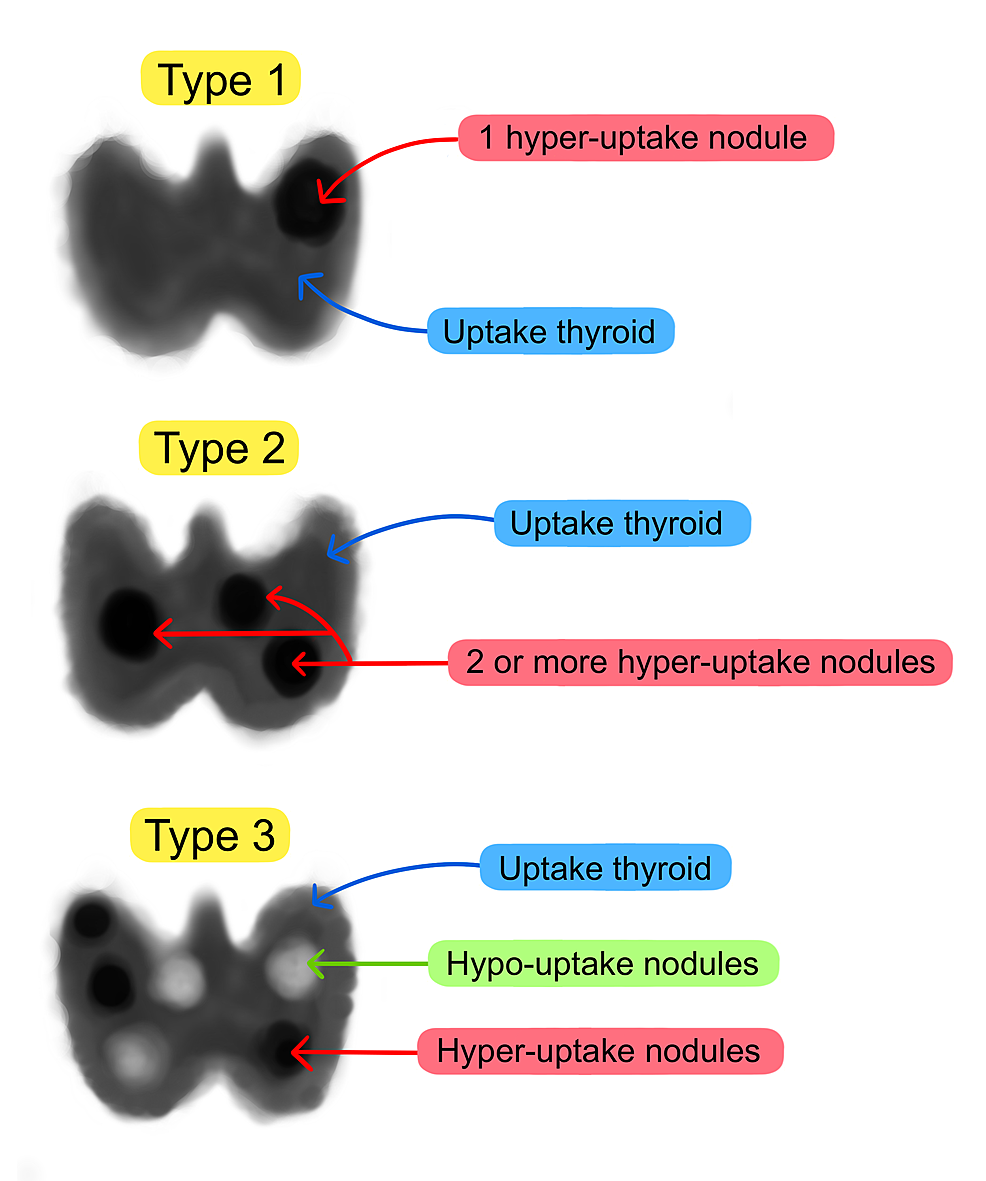 Type 2 Marine-Lenhart Syndrome: An Uncommon Cause of Thyrotoxicosis ...