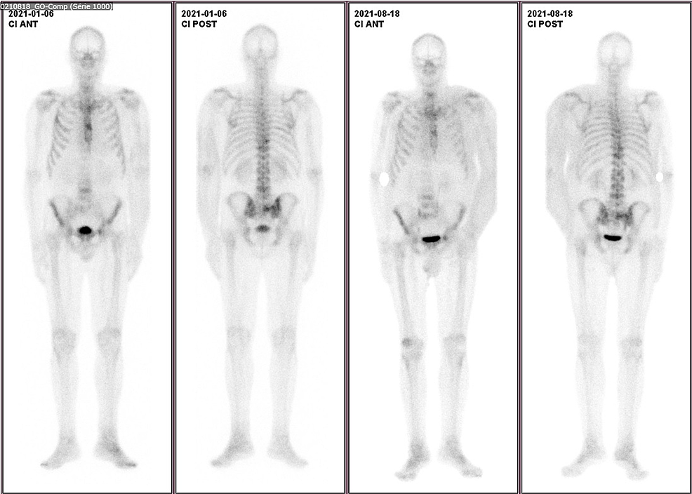 Bone-scintigraphy-with-metastasis-in-the-spine,-iliac-crest,-pelvis,-sternum,-and-ribs