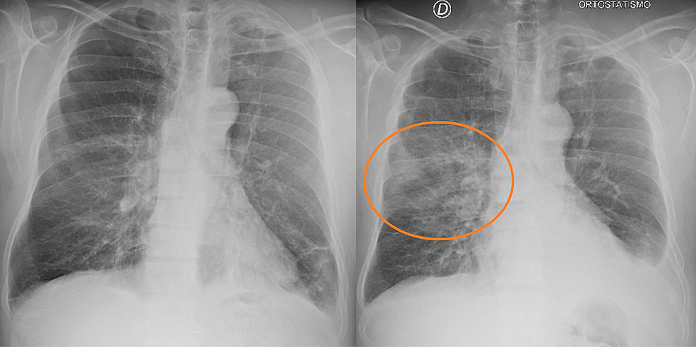 X-ray-of-the-patient-before-(left)-and-after-(right)-radiotherapy