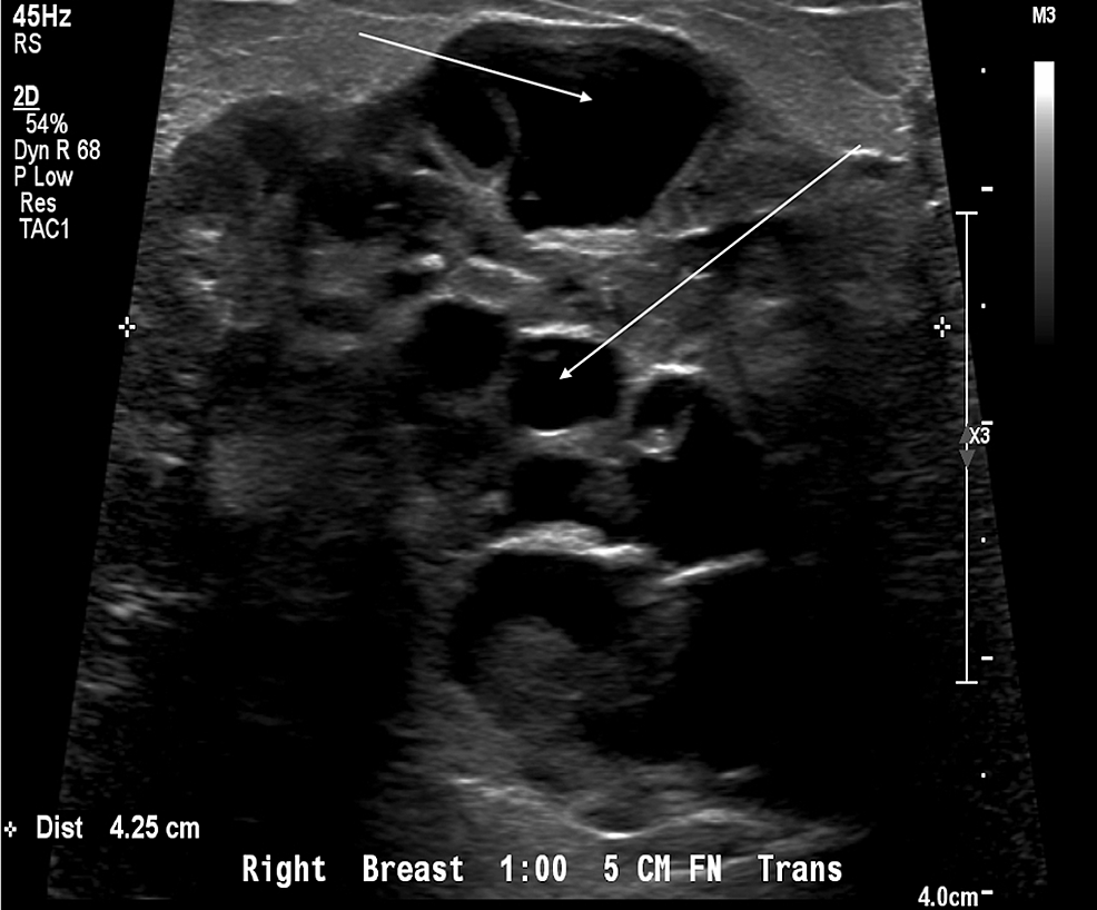 cureus-metaplastic-breast-carcinoma-presenting-as-a-mixed-solid-and