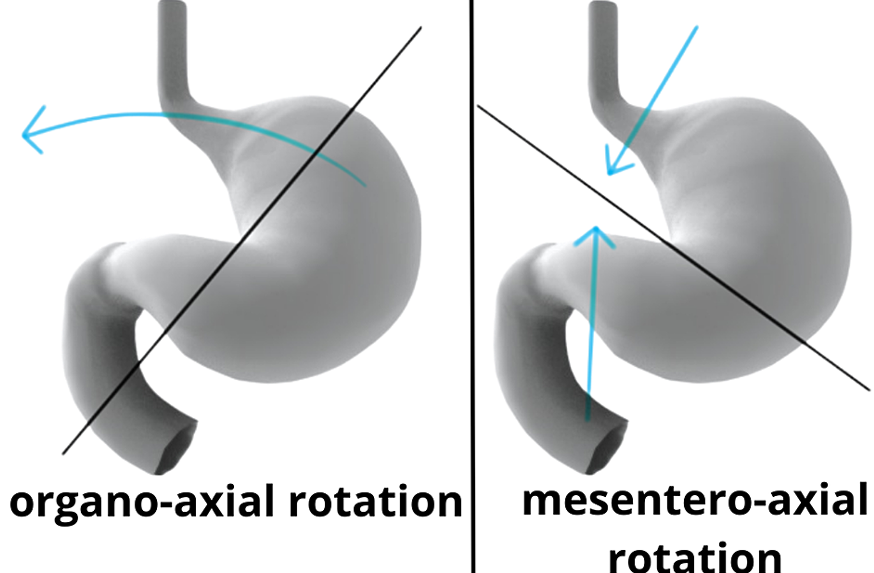 paraesophageal hernia with gastric volvulus