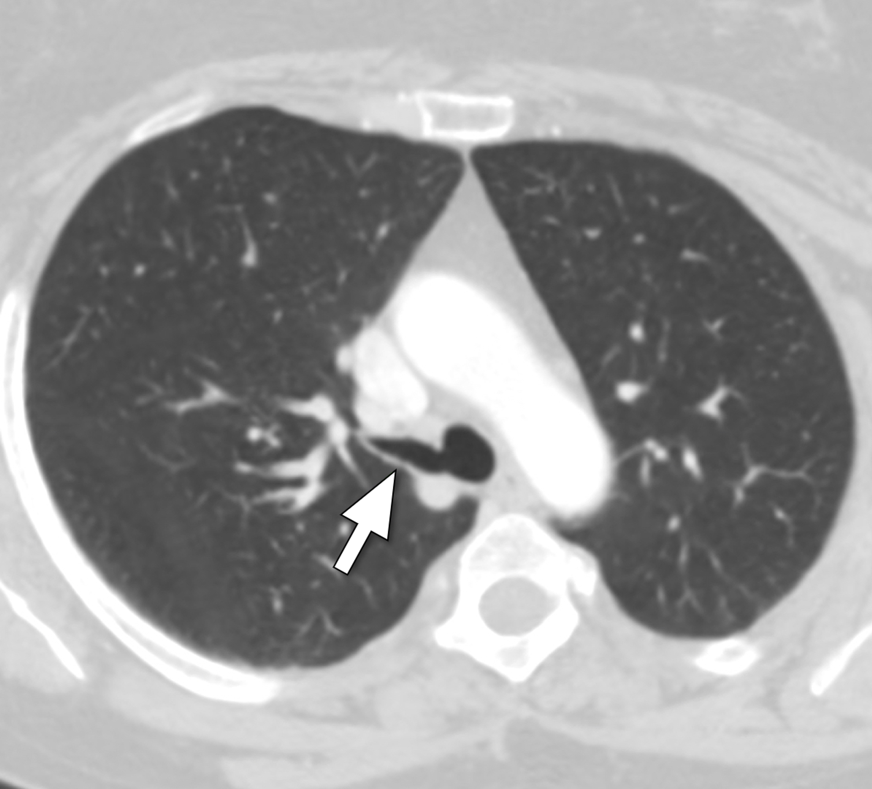 Cureus Tracheal Bronchus A Rare Etiology of Recurrent Pneumonia in