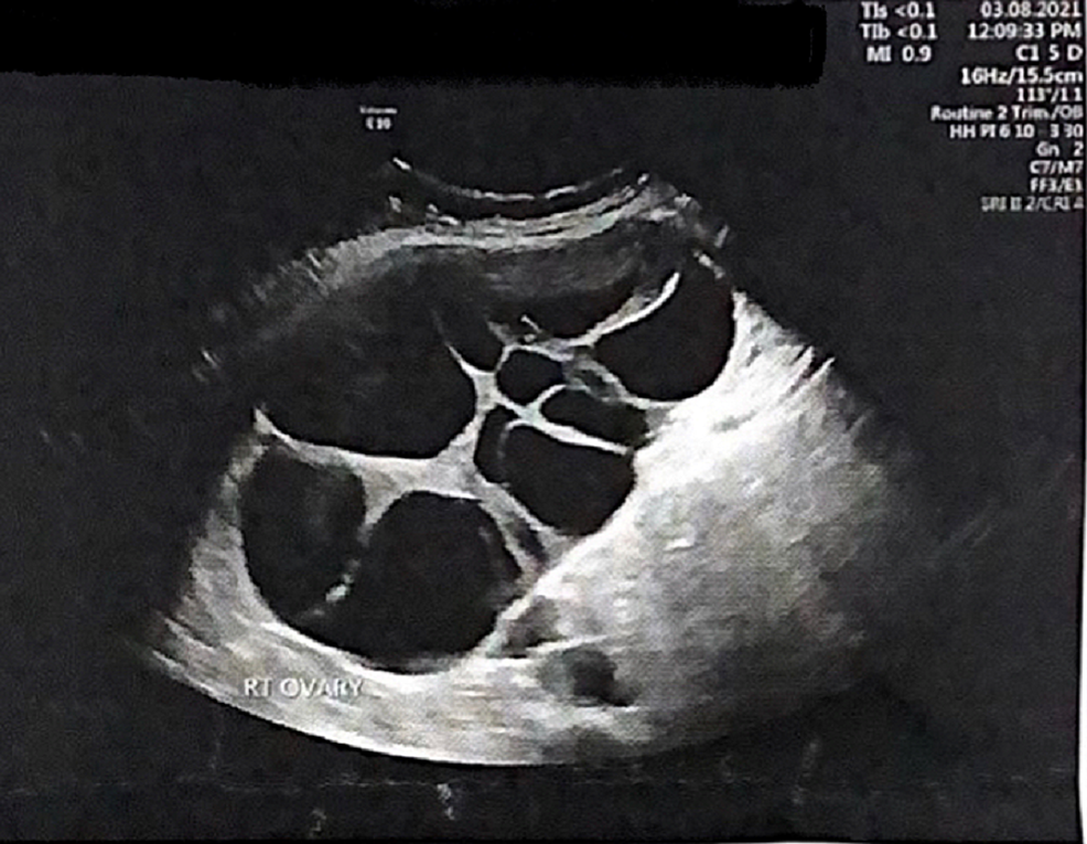 Onset Of Spontaneous Ovarian Hyperstimulation Syndrome In The Third ...