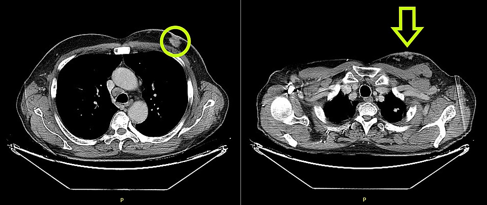 Chest-CT-on-the-left-showing-primitive-breast-cancer-(green-circle)-and-on-the-right-demonstrating-skin-metastasis-(green-arrow)